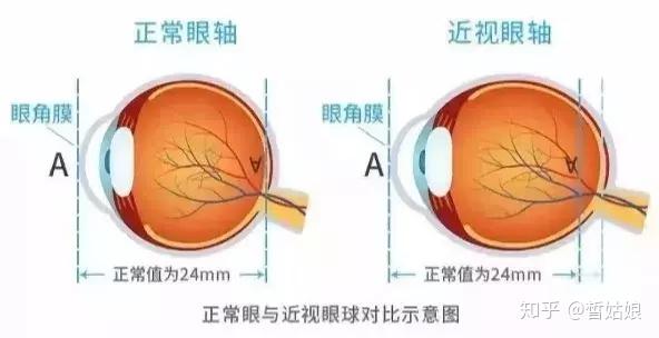 600度近视怎么能降下来