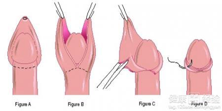 包皮过长做手术要多少钱