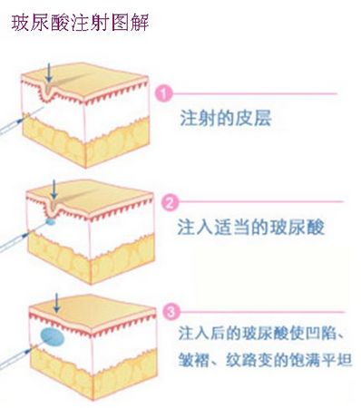 玻尿酸是什么东西提炼,玻尿酸的来源与实地数据分析方案，深入了解玻尿酸提炼及其实地应用,综合评估解析说明_领航款28.81.68