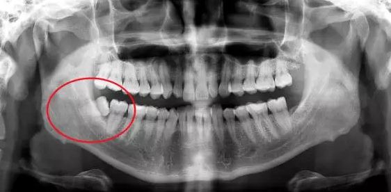 智齿残根需要拔掉吗