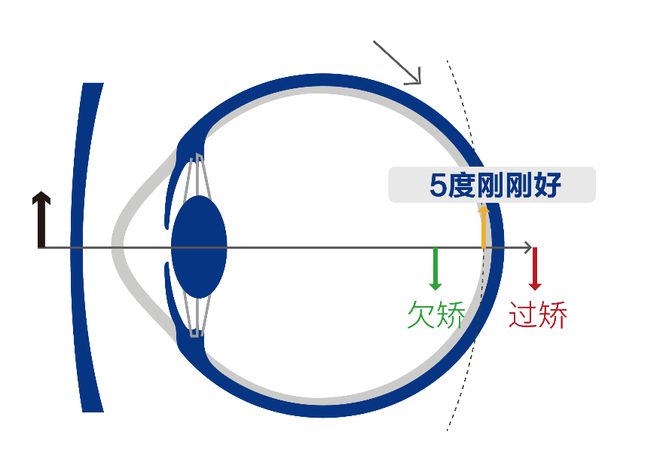 棱镜式透镜近视防控镜