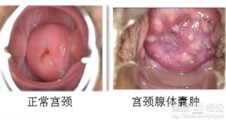 宫颈囊肿是什么意思