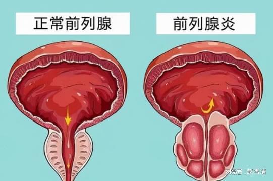 前列腺炎有些什么症状怎么治疗